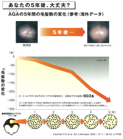 AGAの5年間の毛髪量の変化